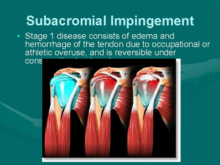 Subacromial Impingement • Stage 1 disease consists of edema and hemorrhage of the tendon