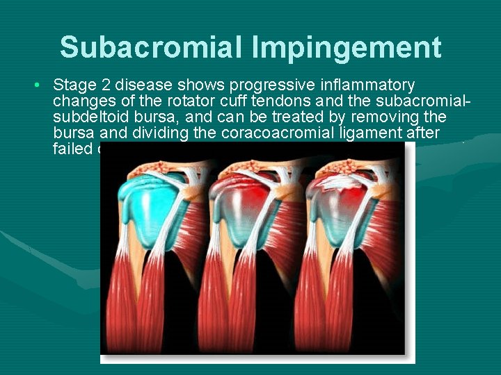 Subacromial Impingement • Stage 2 disease shows progressive inflammatory changes of the rotator cuff