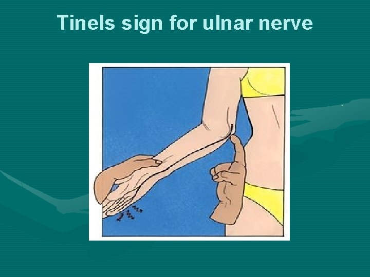 Tinels sign for ulnar nerve 