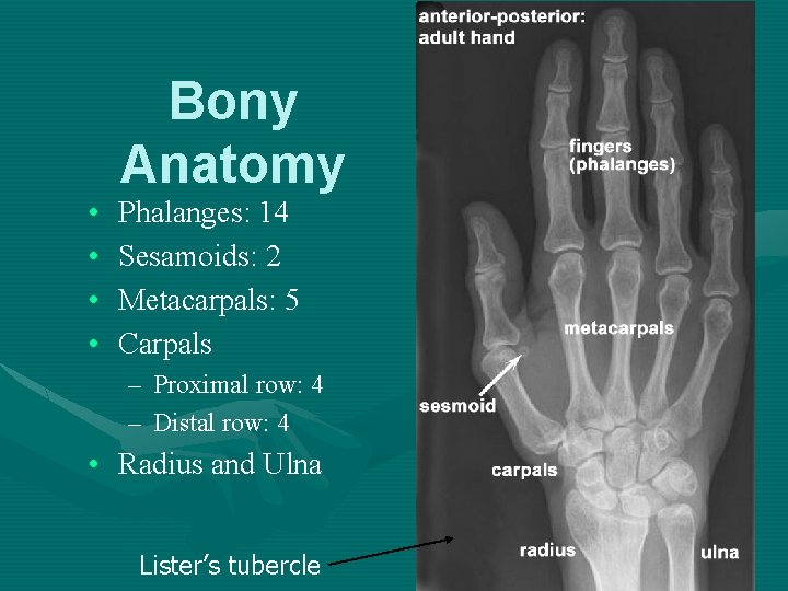 • • Bony Anatomy Phalanges: 14 Sesamoids: 2 Metacarpals: 5 Carpals – Proximal