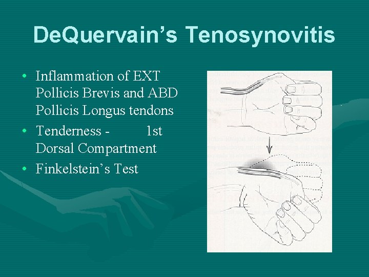 De. Quervain’s Tenosynovitis • Inflammation of EXT Pollicis Brevis and ABD Pollicis Longus tendons