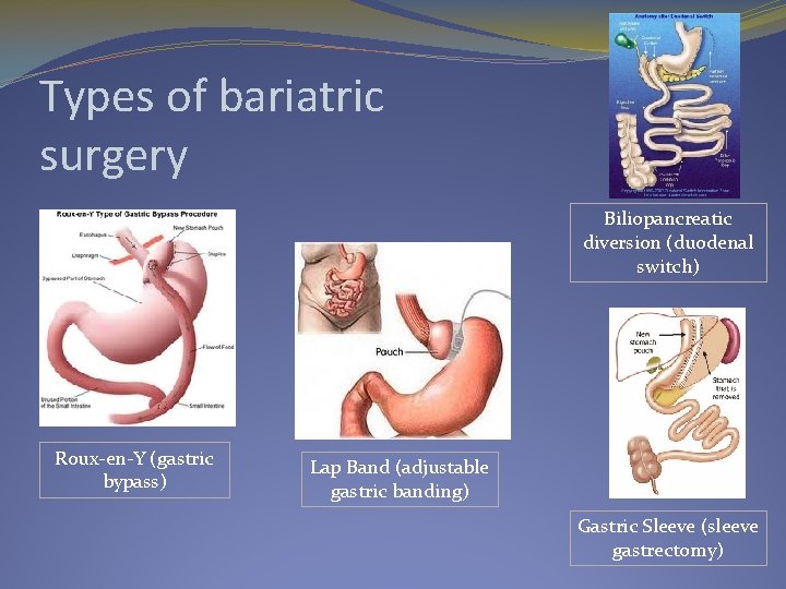 Types of bariatric surgery Biliopancreatic diversion (duodenal switch) Roux-en-Y (gastric bypass) Lap Band (adjustable