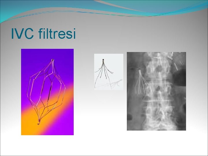 IVC filtresi 