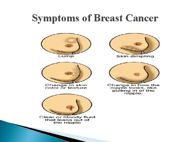 Symptoms of Breast Cancer 