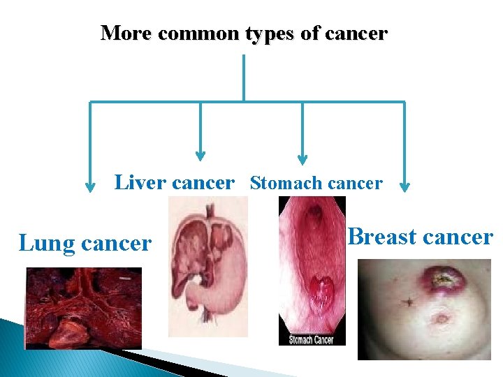 More common types of cancer Liver cancer Stomach cancer Lung cancer Breast cancer 