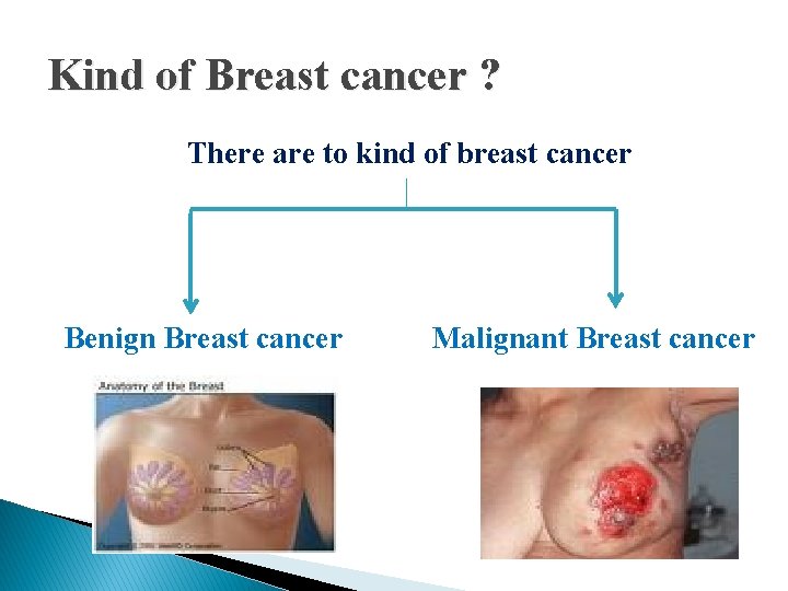 Kind of Breast cancer ? There are to kind of breast cancer Benign Breast