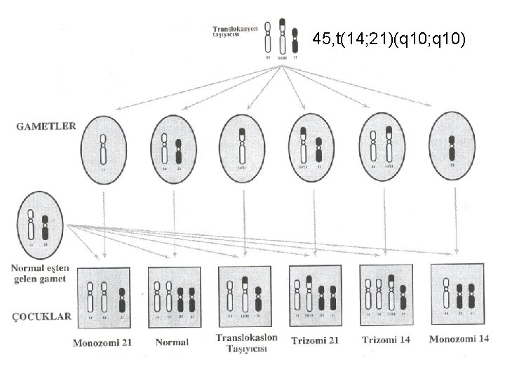 45, t(14; 21)(q 10; q 10) 