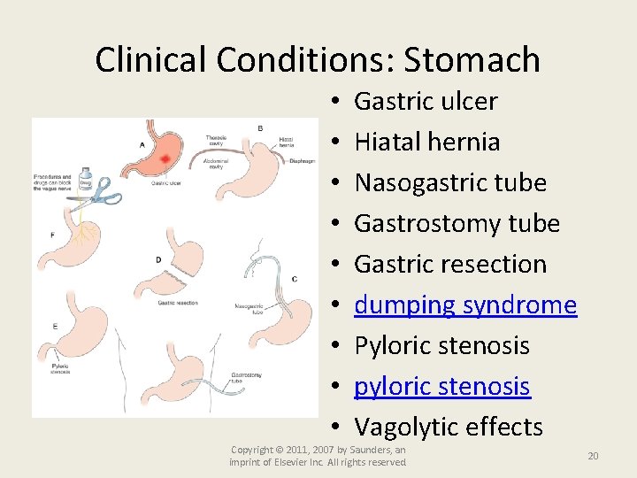 Clinical Conditions: Stomach • • • Gastric ulcer Hiatal hernia Nasogastric tube Gastrostomy tube