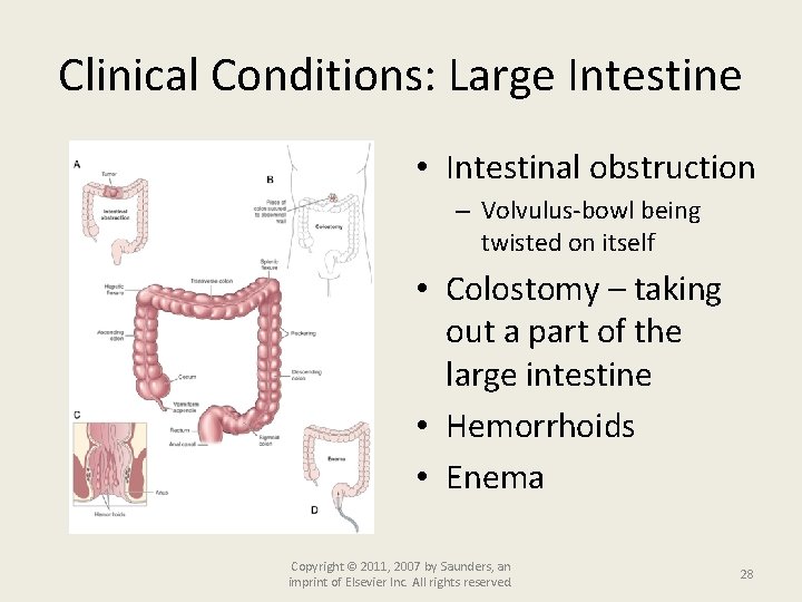 Clinical Conditions: Large Intestine • Intestinal obstruction – Volvulus-bowl being twisted on itself •