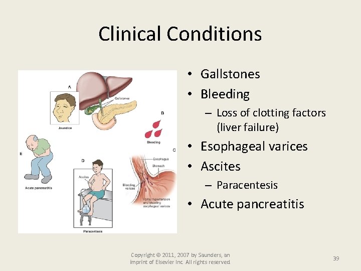 Clinical Conditions • Gallstones • Bleeding – Loss of clotting factors (liver failure) •