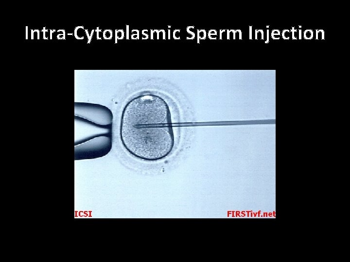 Intra-Cytoplasmic Sperm Injection 