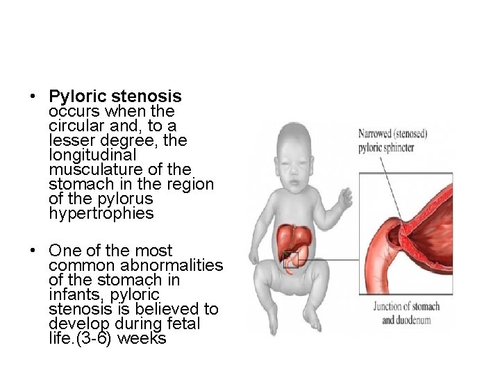  • Pyloric stenosis occurs when the circular and, to a lesser degree, the