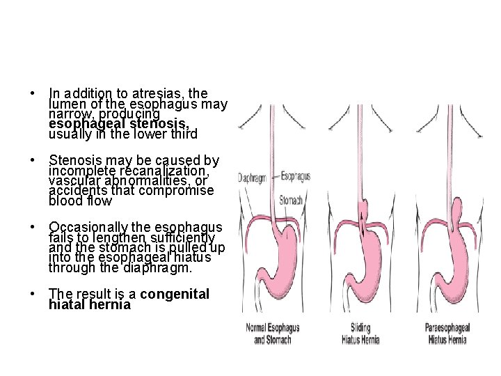  • In addition to atresias, the lumen of the esophagus may narrow, producing