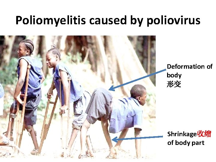 Poliomyelitis caused by poliovirus Deformation of body 形变 Shrinkage收缩 of body part 