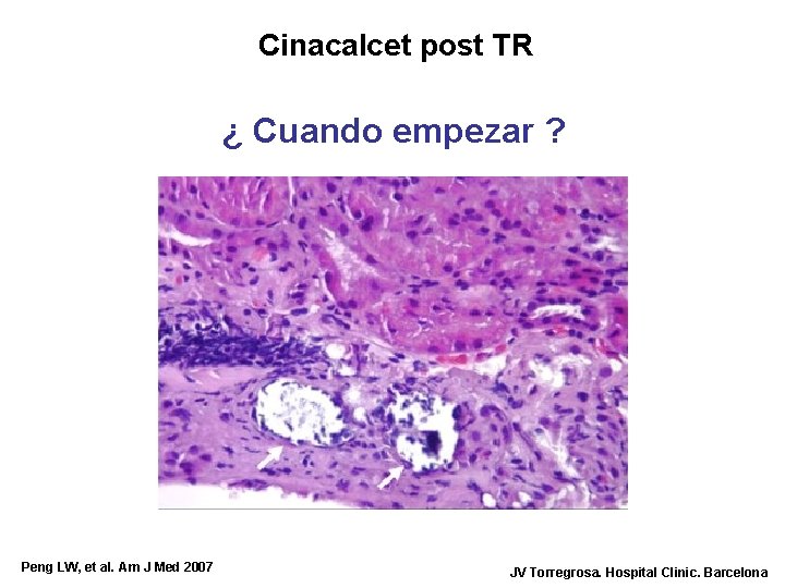 Cinacalcet post TR ¿ Cuando empezar ? Peng LW, et al. Am J Med