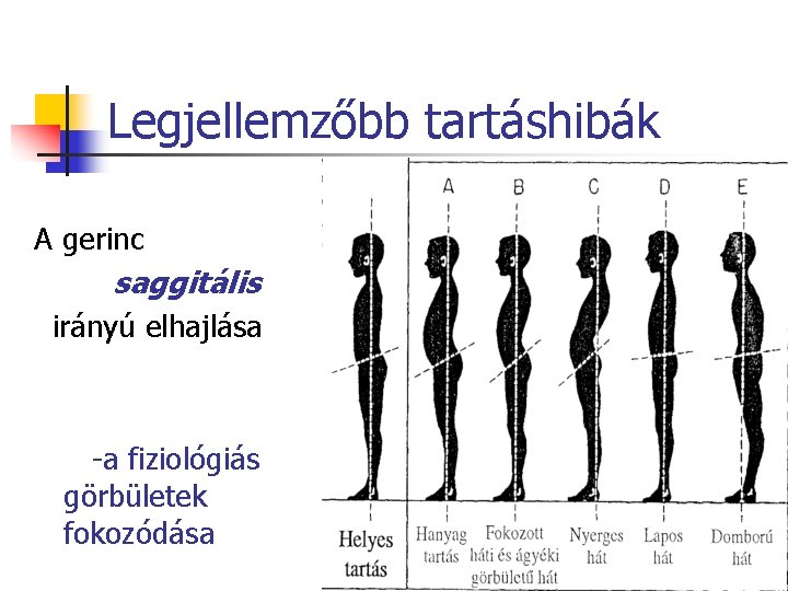 Legjellemzőbb tartáshibák A gerinc saggitális irányú elhajlása -a fiziológiás görbületek fokozódása 