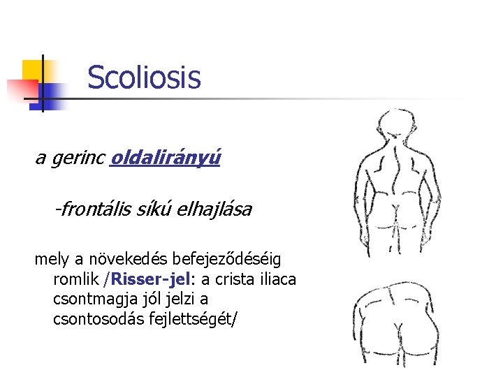 Scoliosis a gerinc oldalirányú -frontális síkú elhajlása mely a növekedés befejeződéséig romlik /Risser-jel: a