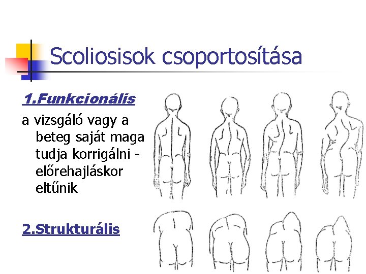 Scoliosisok csoportosítása 1. Funkcionális a vizsgáló vagy a beteg saját maga tudja korrigálni előrehajláskor