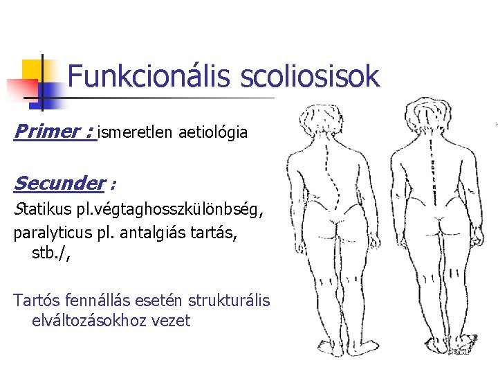 Funkcionális scoliosisok Primer : ismeretlen aetiológia Secunder : Statikus pl. végtaghosszkülönbség, paralyticus pl. antalgiás