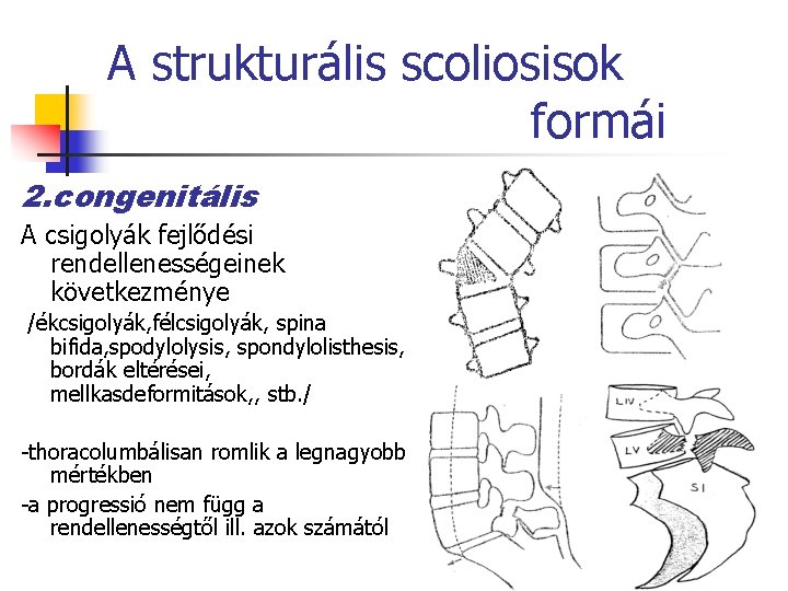 A strukturális scoliosisok formái 2. congenitális A csigolyák fejlődési rendellenességeinek következménye /ékcsigolyák, félcsigolyák, spina