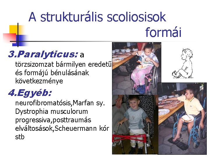 A strukturális scoliosisok formái 3. Paralyticus: a törzsizomzat bármilyen eredetű és formájú bénulásának következménye