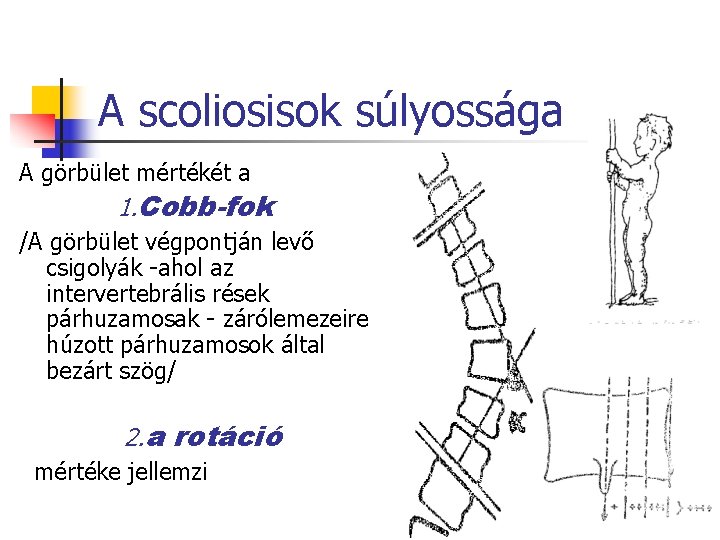 A scoliosisok súlyossága A görbület mértékét a 1. Cobb-fok /A görbület végpontján levő csigolyák