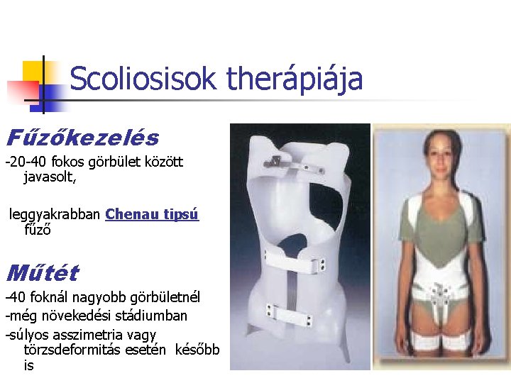 Scoliosisok therápiája Fűzőkezelés -20 -40 fokos görbület között javasolt, leggyakrabban Chenau tipsú fűző Műtét