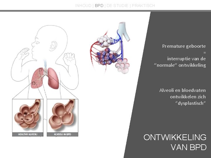 INHOUD | BPD | DE STUDIE | PRAKTISCH Premature geboorte = interruptie van de