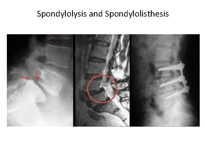 Spondylolysis and Spondylolisthesis 