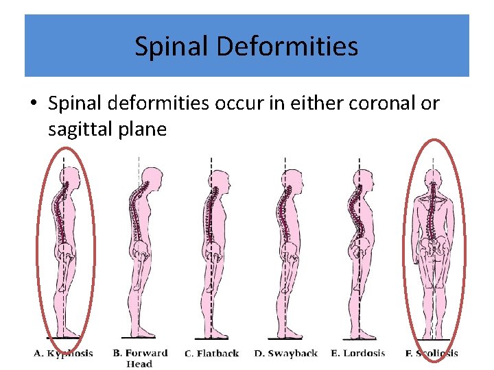 Spinal Deformities • Spinal deformities occur in either coronal or sagittal plane 