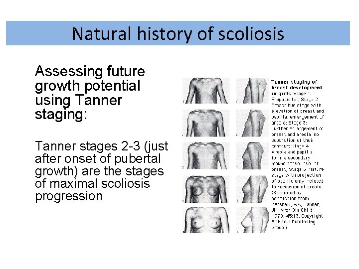 Natural history of scoliosis Assessing future growth potential using Tanner staging: Tanner stages 2