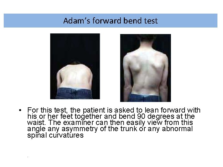 Adam’s forward bend test • For this test, the patient is asked to lean