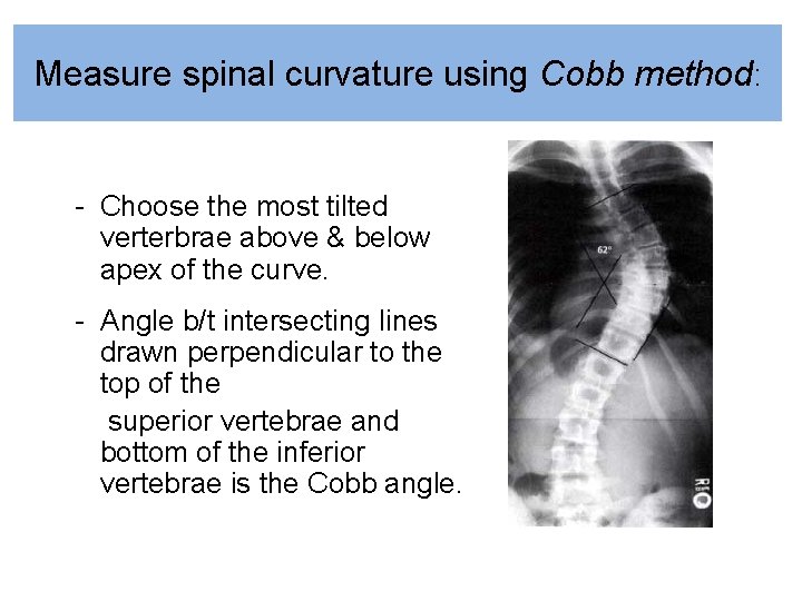 Measure spinal curvature using Cobb method: - Choose the most tilted verterbrae above &