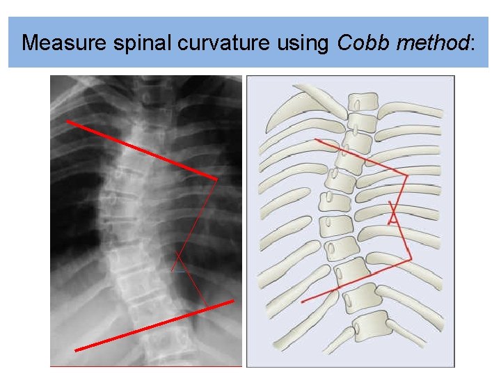 Measure spinal curvature using Cobb method: 