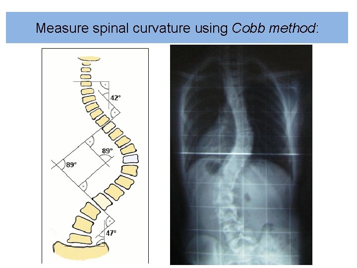 Measure spinal curvature using Cobb method: 