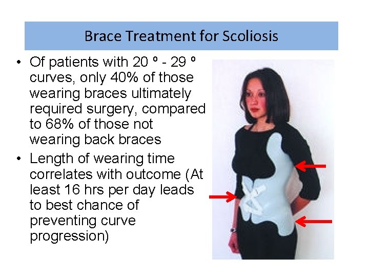 Brace Treatment for Scoliosis • Of patients with 20 º - 29 º curves,