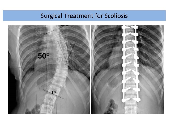 Surgical Treatment for Scoliosis 