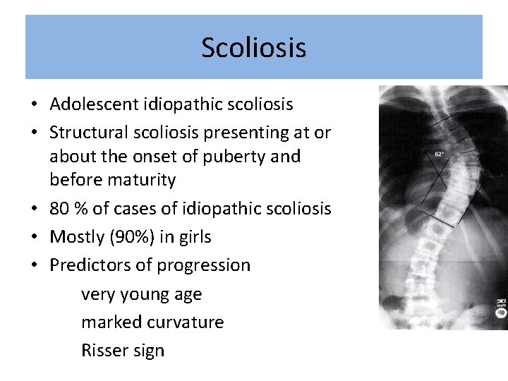 Scoliosis • Adolescent idiopathic scoliosis • Structural scoliosis presenting at or about the onset