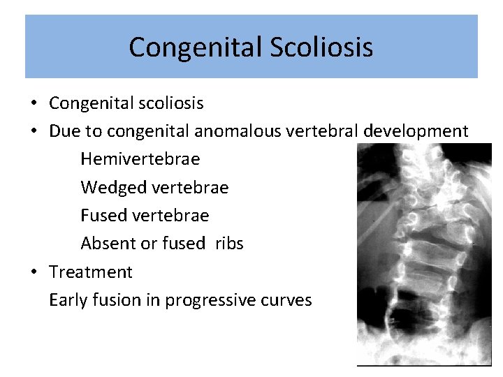 Congenital Scoliosis • Congenital scoliosis • Due to congenital anomalous vertebral development Hemivertebrae Wedged
