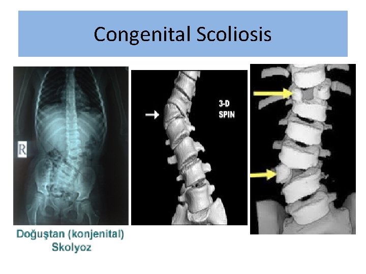 Congenital Scoliosis 