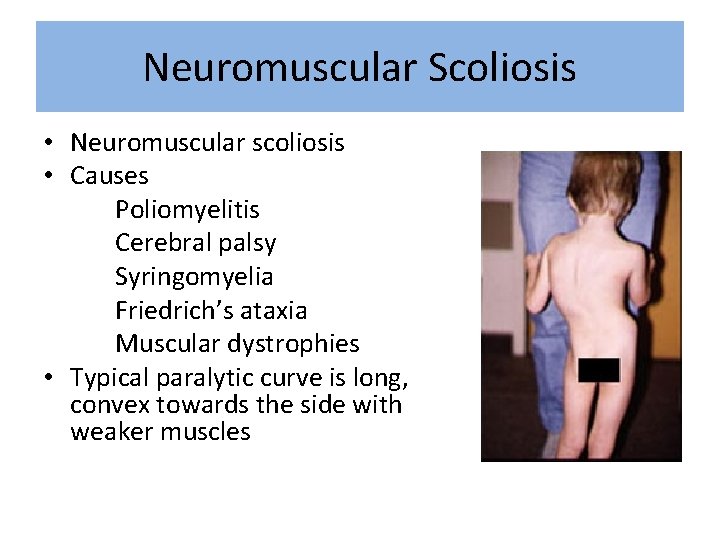 Neuromuscular Scoliosis • Neuromuscular scoliosis • Causes Poliomyelitis Cerebral palsy Syringomyelia Friedrich’s ataxia Muscular
