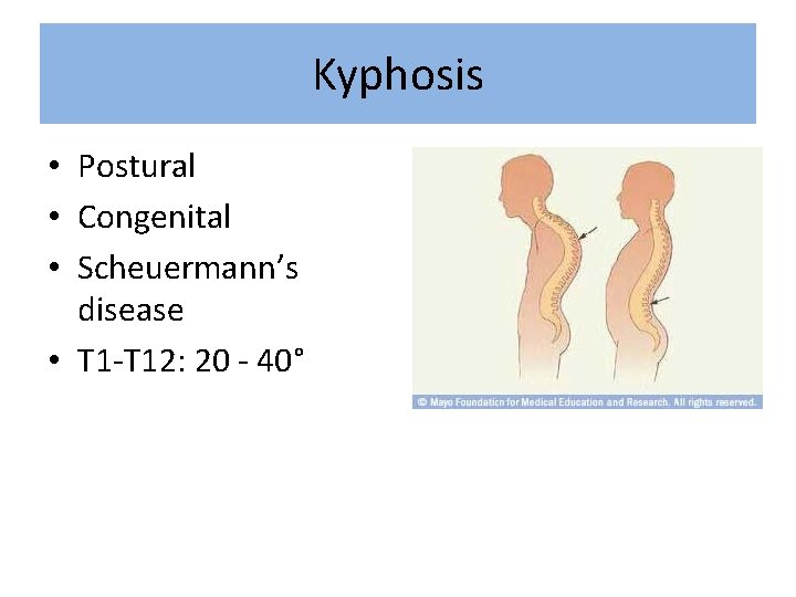 Kyphosis • Postural • Congenital • Scheuermann’s disease • T 1 -T 12: 20