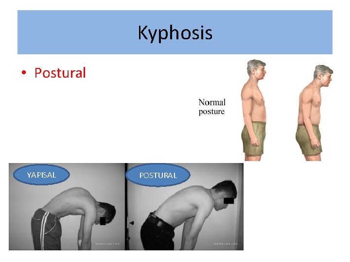Kyphosis • Postural YAPISAL POSTURAL 