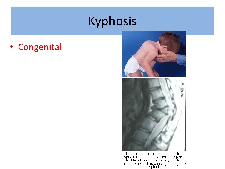 Kyphosis • Congenital 