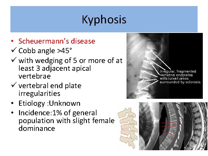 Kyphosis • Scheuermann’s disease ü Cobb angle >45° ü with wedging of 5 or