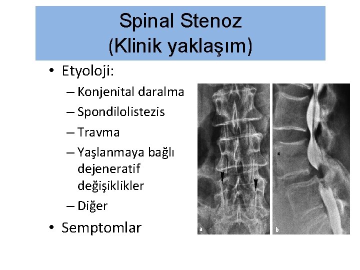 Spinal Stenoz (Klinik yaklaşım) • Etyoloji: – Konjenital daralma – Spondilolistezis – Travma –