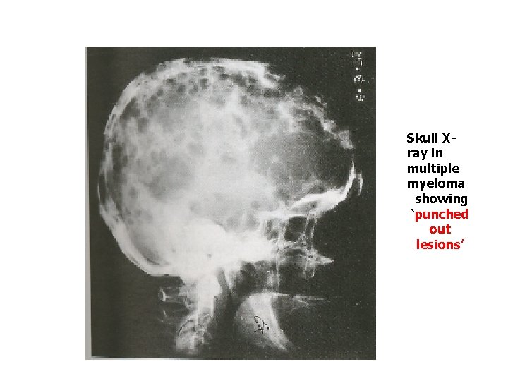 Skull Xray in multiple myeloma showing ‘punched out lesions’ 