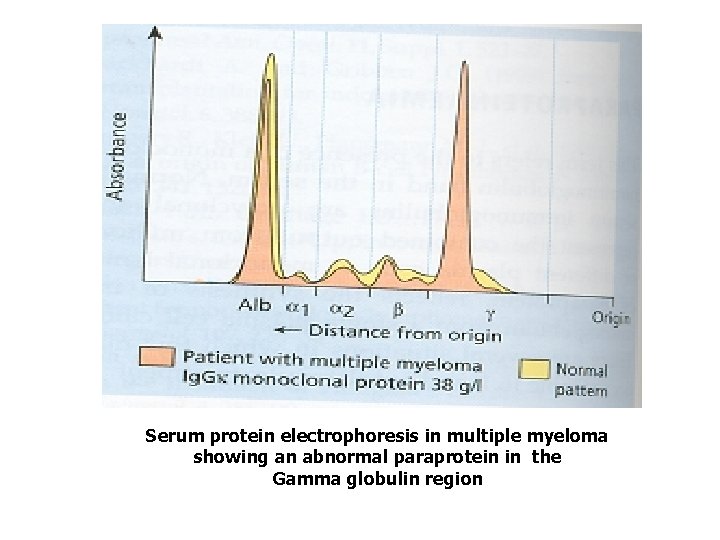 Serum protein electrophoresis in multiple myeloma showing an abnormal paraprotein in the Gamma globulin