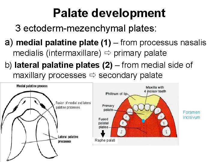 Palate development 3 ectoderm-mezenchymal plates: a) medial palatine plate (1) – from processus nasalis