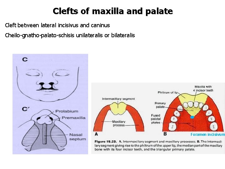 Clefts of maxilla and palate Cleft between lateral incisivus and caninus Cheilo-gnatho-palato-schisis unilateralis or